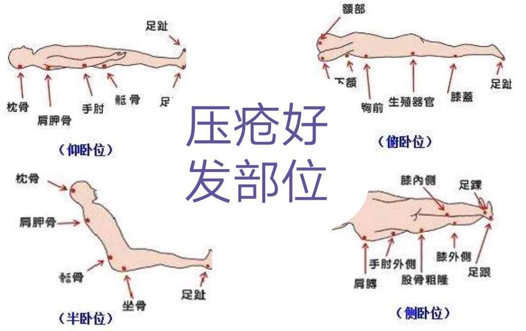 压疮分期与护理方法解析