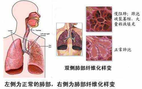 肺纤维化最新治疗方案研究与进展综述